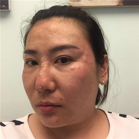 注射注射瘦臉去魚尾紋前后對比果照片分享，大同清木姜際珠做的~