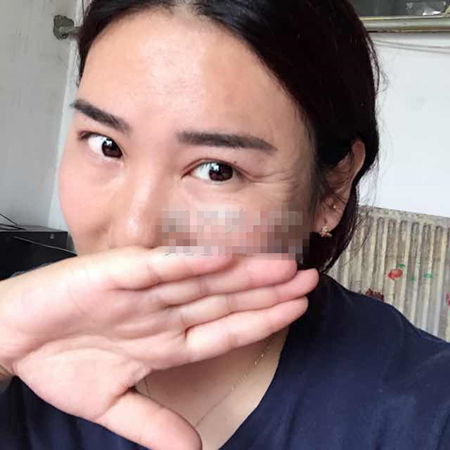 注射注射瘦臉去魚尾紋前后對比果照片分享，大同清木姜際珠做的~