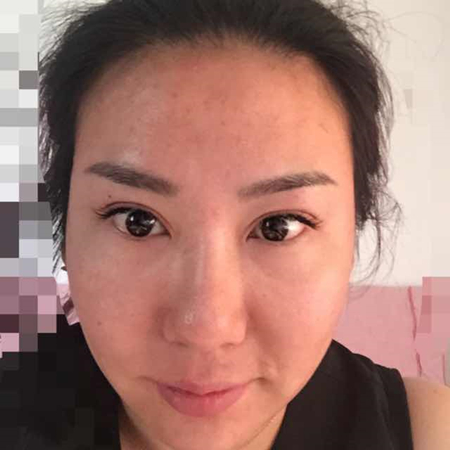 注射注射瘦臉去魚尾紋前后對比果照片分享，大同清木姜際珠做的~