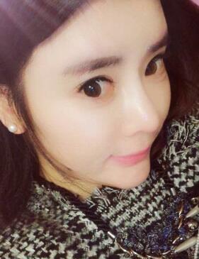 自體脂肪豐太陽穴兩個半月