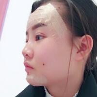 自體脂肪面部填充恢復(fù)過程分享，填充價(jià)格12000元