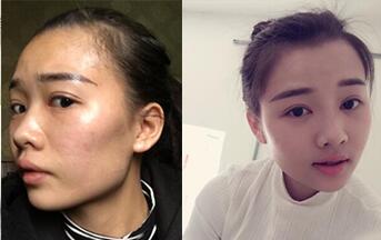 自體脂肪填充全臉整形前后對比圖