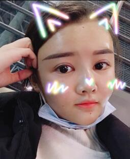 自體脂肪面部填充第三天