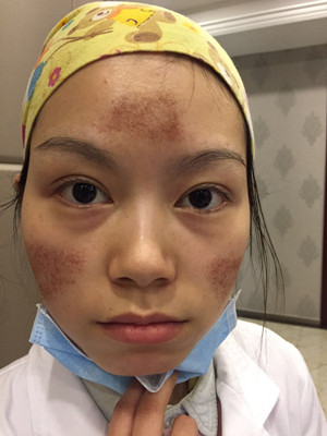 點(diǎn)陣激光祛痘前后過程對比照片分享，大家來看看果怎么樣