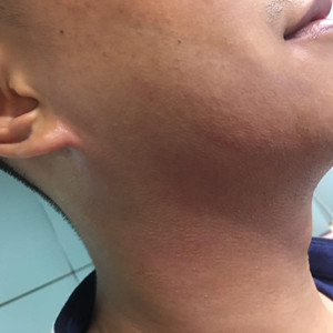 高強(qiáng)度聚焦超聲除掉小細(xì)紋，不再是女人的專*，我也可以擁有!!!