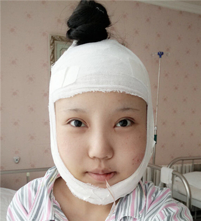 v－line瓜子臉整形手術前后照片分享，丹東市第(一)醫(yī)院郎勁松做的~