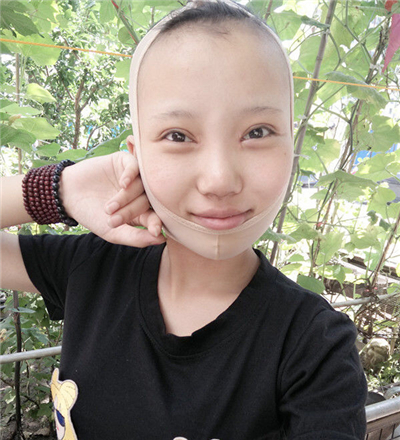 v－line瓜子臉整形手術前后照片分享，丹東市第(一)醫(yī)院郎勁松做的~