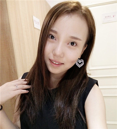 v－line瓜子臉整形手術前后照片分享，丹東市第(一)醫(yī)院郎勁松做的~