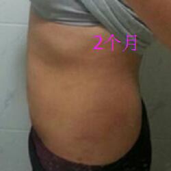 肚子減肥的方法就是吸脂減肥瘦腰腹了，親身經(jīng)歷分享