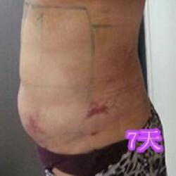 吸脂減肥瘦腰腹術(shù)后2個(gè)月的恢復(fù)對(duì)比圖片