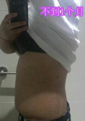 吸脂減肥瘦腰腹術(shù)后近一個(gè)月恢復(fù)果