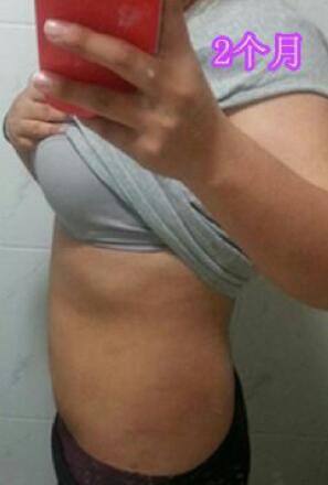 吸脂減肥2個(gè)多月了，果很滿意