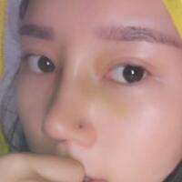 鼻子整形價格10000元，隆鼻手術(shù)過程圖分享