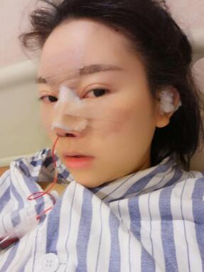 鼻子整形手術(shù)過(guò)后