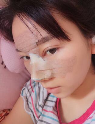 鼻子整形第二天