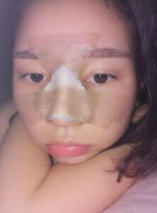 鼻子整形第四天