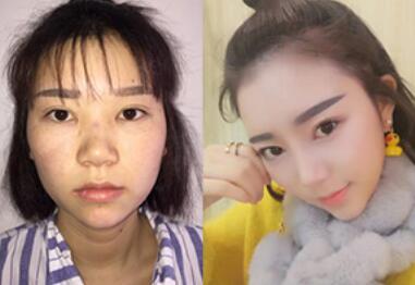 隆鼻整形前后對(duì)比圖