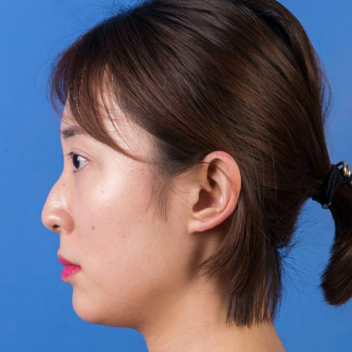 這個月剛做了駝峰鼻矯正整形手術(shù)，分享術(shù)前術(shù)后的照片~