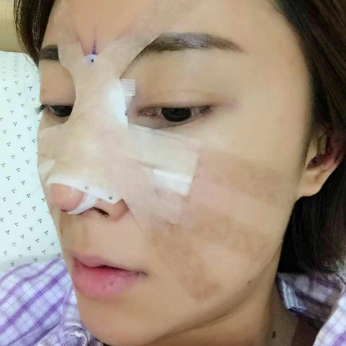 這個月剛做了駝峰鼻矯正整形手術(shù)，分享術(shù)前術(shù)后的照片~