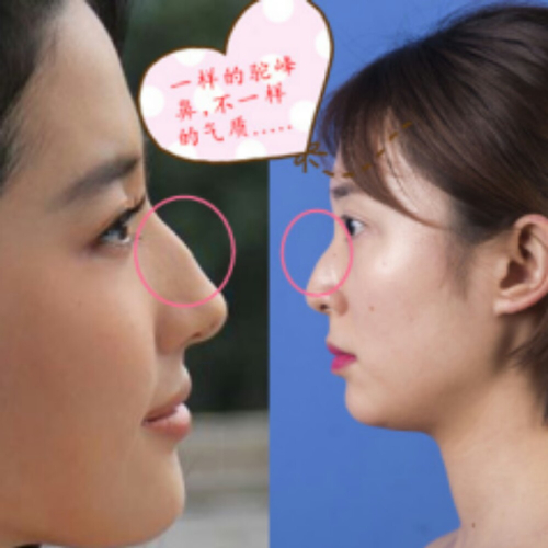 這個月剛做了駝峰鼻矯正整形手術(shù)，分享術(shù)前術(shù)后的照片~