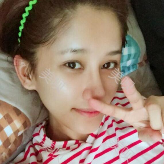 膨體隆鼻后我也有了像明星那樣的小翹鼻了