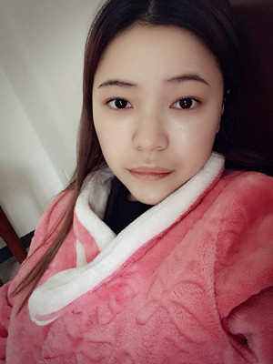 去年12月做的自體脂肪填充蘋果肌，大家來看看果怎么樣?