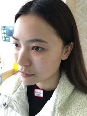 去年12月做的自體脂肪填充蘋果肌，大家來看看果怎么樣?