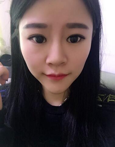 玻尿酸隆鼻恢復(fù)過程圖