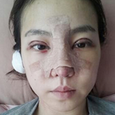 隆鼻整形+切開雙眼皮三個月恢復(fù)照片分享，莆田維納斯做的~