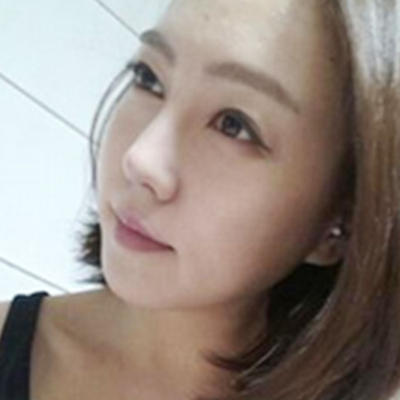 隆鼻整形+切開雙眼皮三個月恢復(fù)照片分享，莆田維納斯做的~