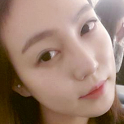 隆鼻整形+切開雙眼皮三個月恢復(fù)照片分享，莆田維納斯做的~