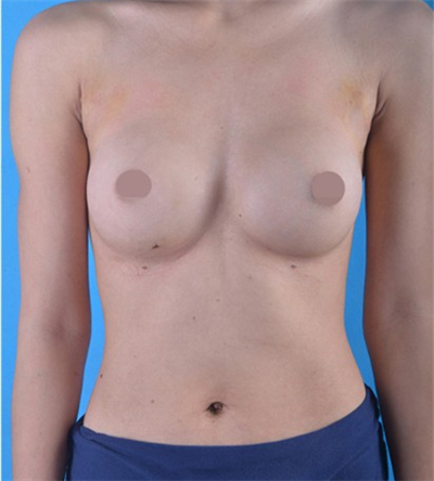 250cc假體隆胸手術(shù)恢復(fù)過程和前后對比果圖片分享~