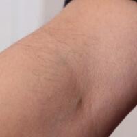 從小我就毛發(fā)旺盛，做了激光脫毛果圖分享給大家