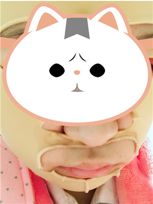 磨下頜角改臉型手術(shù)的變美歷程