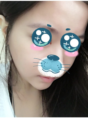 磨下頜角改臉型手術(shù)的變美歷程