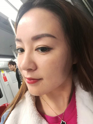 埋埋蛋白線.提升術(shù)之后氣色都變好了喲