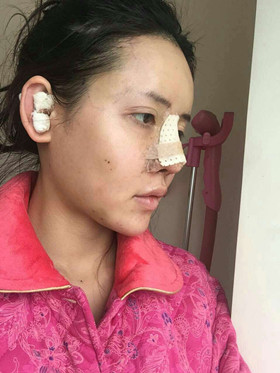自體軟骨隆鼻+自體脂肪豐蘋果肌，成功逆襲成女神