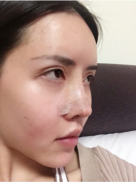 自體軟骨隆鼻+自體脂肪豐蘋果肌，成功逆襲成女神