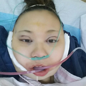 切開雙眼皮+磨下頜角，記錄了手術前后的過程，給大家分享一下