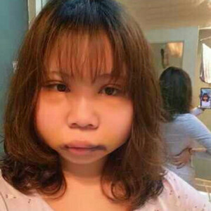 切開雙眼皮+磨下頜角，記錄了手術前后的過程，給大家分享一下