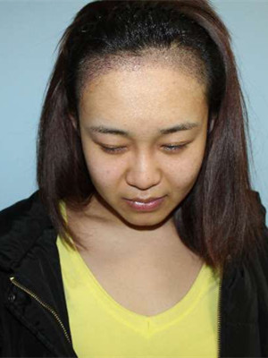 做了發(fā)際線種植手術(shù)，感覺還不錯(cuò)!