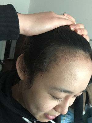 做了發(fā)際線種植手術(shù)，感覺還不錯(cuò)!