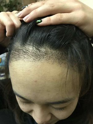 做了發(fā)際線種植手術(shù)，感覺還不錯(cuò)!