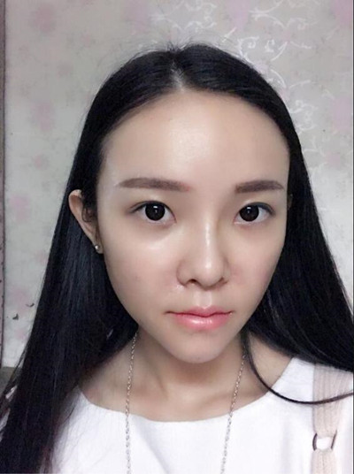 我的自體脂肪填充下巴+蘋果肌的恢復(fù)過程 自體脂肪真的是一個(gè)好東西