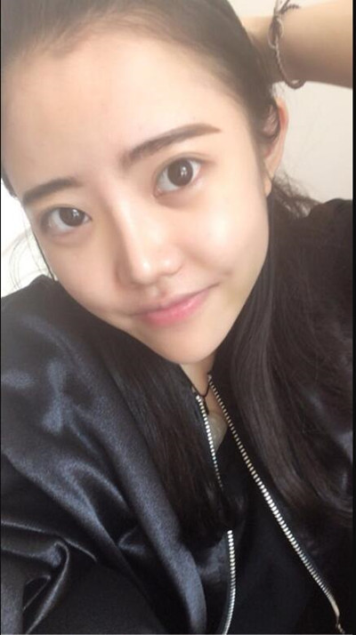 我的隆鼻整形恢復(fù)前后對(duì)果圖 一個(gè)字帥