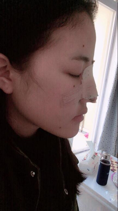 我的隆鼻整形恢復(fù)前后對(duì)果圖 一個(gè)字帥