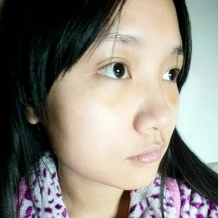 激光去眼袋半個月了，分享恢復(fù)照片，果棒棒的~~