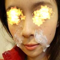 玻尿酸填充法令紋恢復(fù)過程分享，注射價格3000元