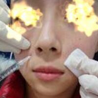 玻尿酸填充法令紋恢復(fù)過程分享，注射價格3000元