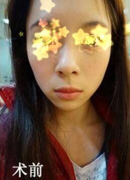 填充法令紋的手術